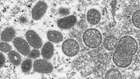 Diese elektronenmikroskopische Aufnahme aus dem Jahr 2003, die von den Centers for Disease Control and Prevention zur Verfügung gestellt wurde, zeigt reife, ovale Affenpockenviren (l) und kugelförmige unreife Virionen (r), die aus einer menschlichen Hautprobe im Zusammenhang mit dem Präriehundeausbruch von 2003 stammt. (Foto: dpa Bildfunk, picture alliance/dpa/Russell Regner/CDC/AP | Cynthia S. Goldsmith)