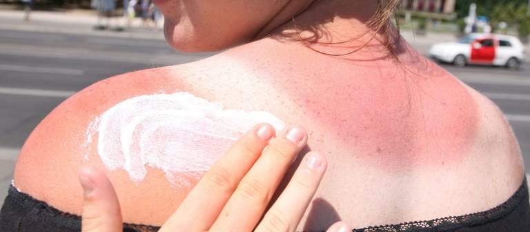 Eine Frau mit Sonnenbrand bekommt den Rücken mit Sonnencreme eingecremt. In Deutschland ist die Anzahl der Todesfälle durch Hautkrebs in den letzten 20 Jahren stark angestiegen. (Foto: dpa Bildfunk, picture alliance/dpa | Stephanie Pilick)
