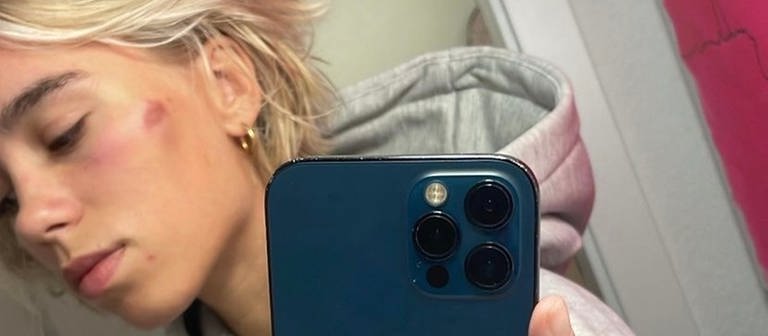 Selfie von Lena Mantler mit blauem Auge nach Zivilcourage (Foto: Screenshot Instagram @lena)