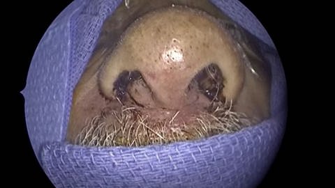 Nase eines Mannes - Darin wurden 150 lebende Käfer-Larven entdeckt (Foto: Screenshot YouTube/First Coast News)