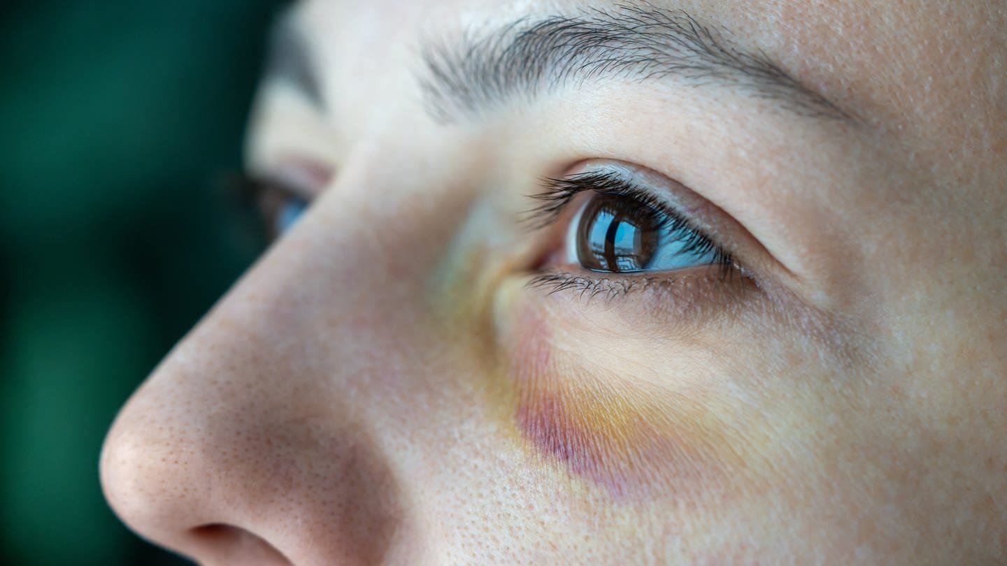 Frau mit blauem Auge (Foto: IMAGO, Symbolbild IMAGO / Pond5 Images)