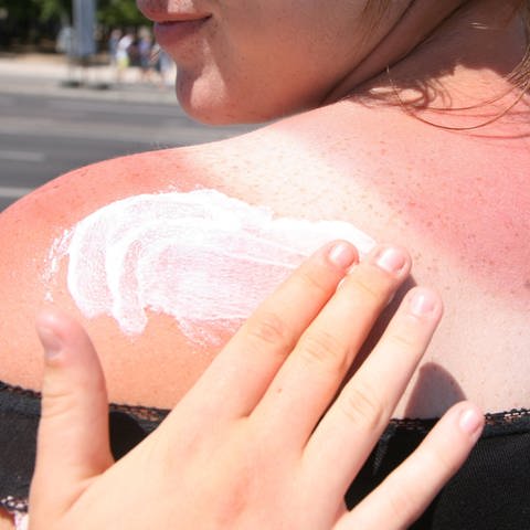 Eine Frau mit Sonnenbrand bekommt den Rücken mit Sonnencreme eingecremt. In Deutschland ist die Anzahl der Todesfälle durch Hautkrebs in den letzten 20 Jahren stark angestiegen.